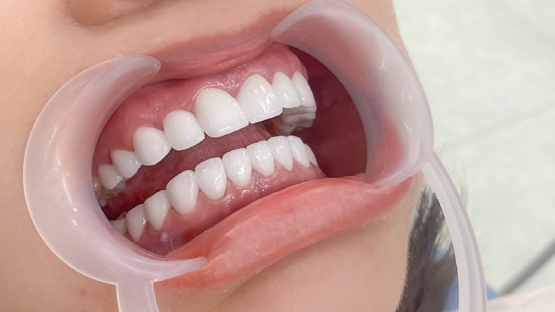 Hình ảnh trước và sau