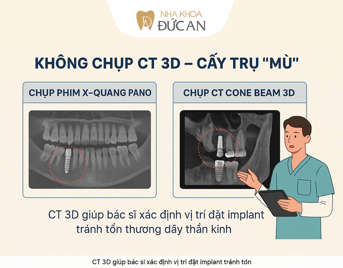 5 Sai lầm khi Trồng Implant Nha Trang khiến nhiều người gặp biến chứng