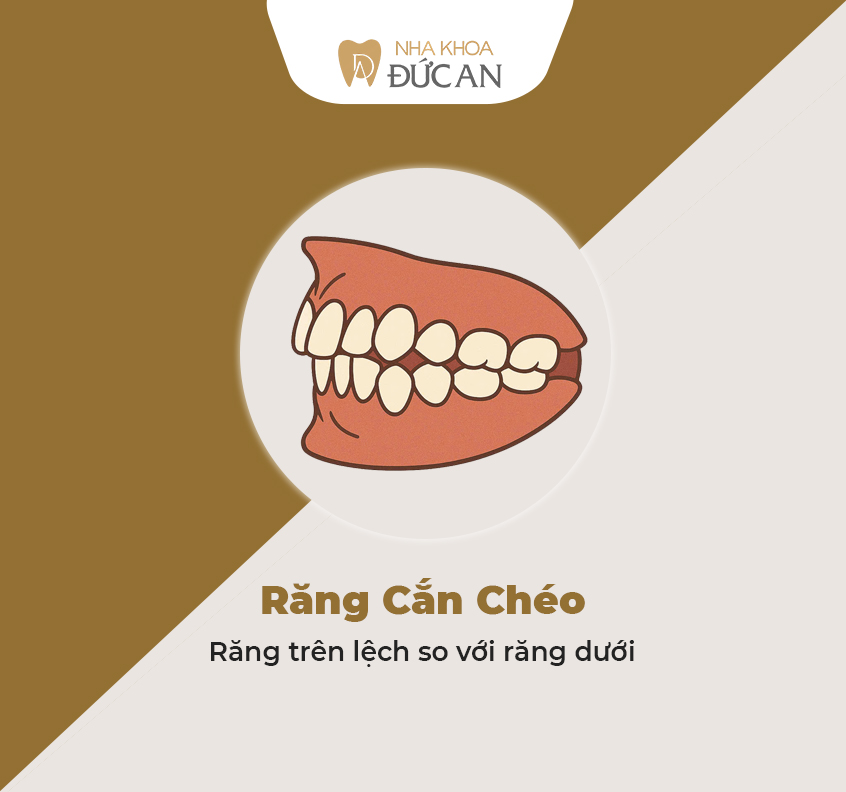 6 Kiểu Răng Lệch Bạn Nên Niềng Răng Nha Trang Đức An Dental Ngay!