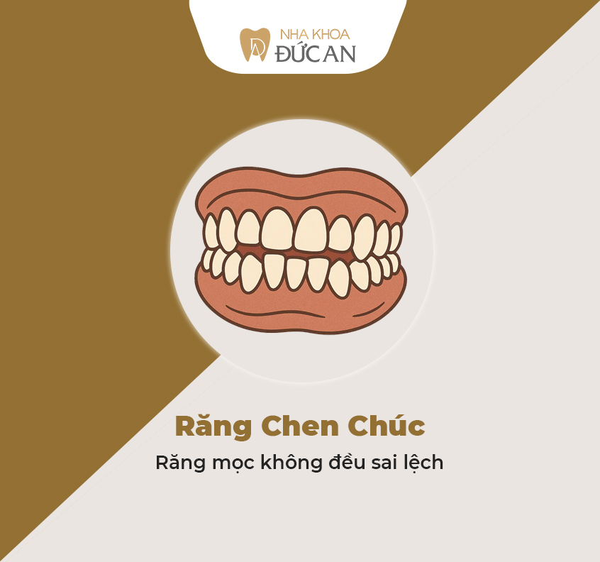 6 Kiểu Răng Lệch Bạn Nên Niềng Răng Nha Trang Đức An Dental Ngay!