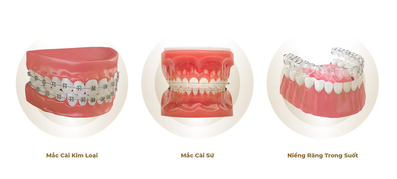 Vì Sao Niềng Răng Tại Nha Trang Ở Nha Khoa Đức An Khiến Hàng Trăm Người Tin Chọn?