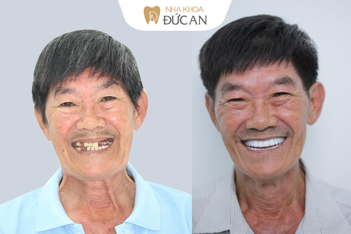 Chi phí Niềng răng & Implant Nha Trang 2025 – Đắt hay rẻ? So sánh thực tế