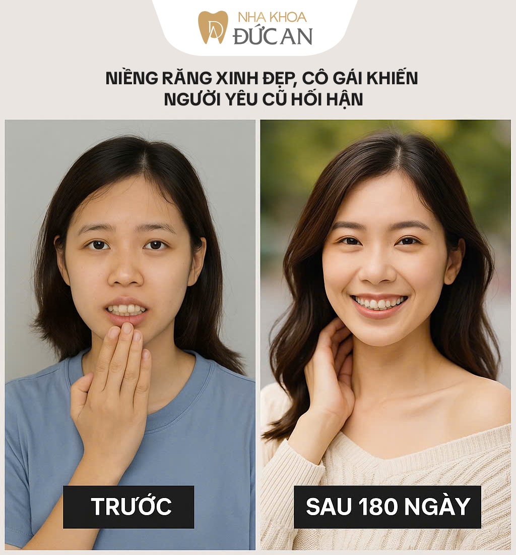 Hành trình Niềng Răng 180 ngày ở Nha Trang, Cú lột xác khiến người cũ hối hận