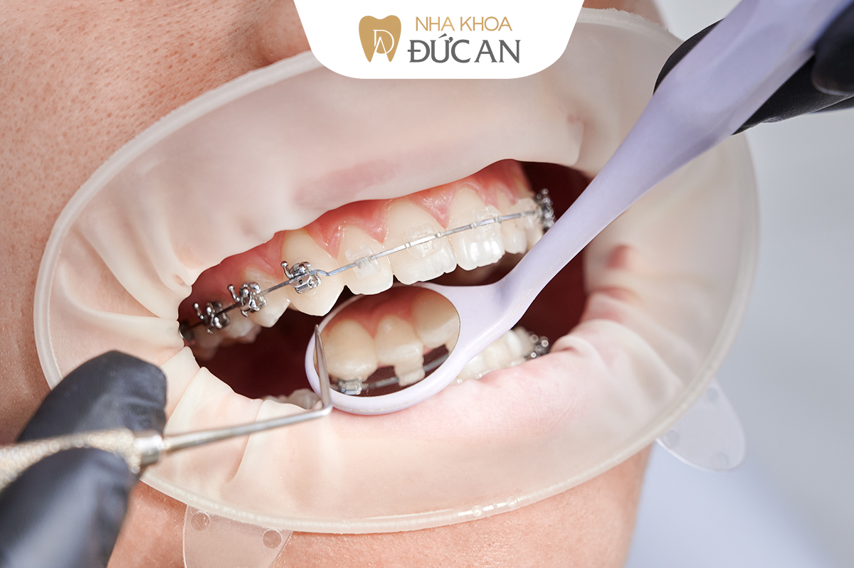 Hành trình Niềng Răng 180 ngày ở Nha Trang, Cú lột xác khiến người cũ hối hận