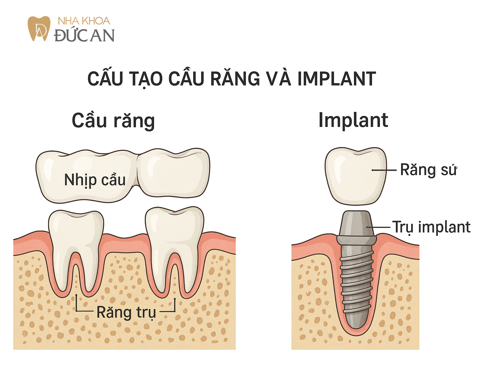 So sánh Cầu Răng và Implant – Giải pháp nào bền vững hơn?