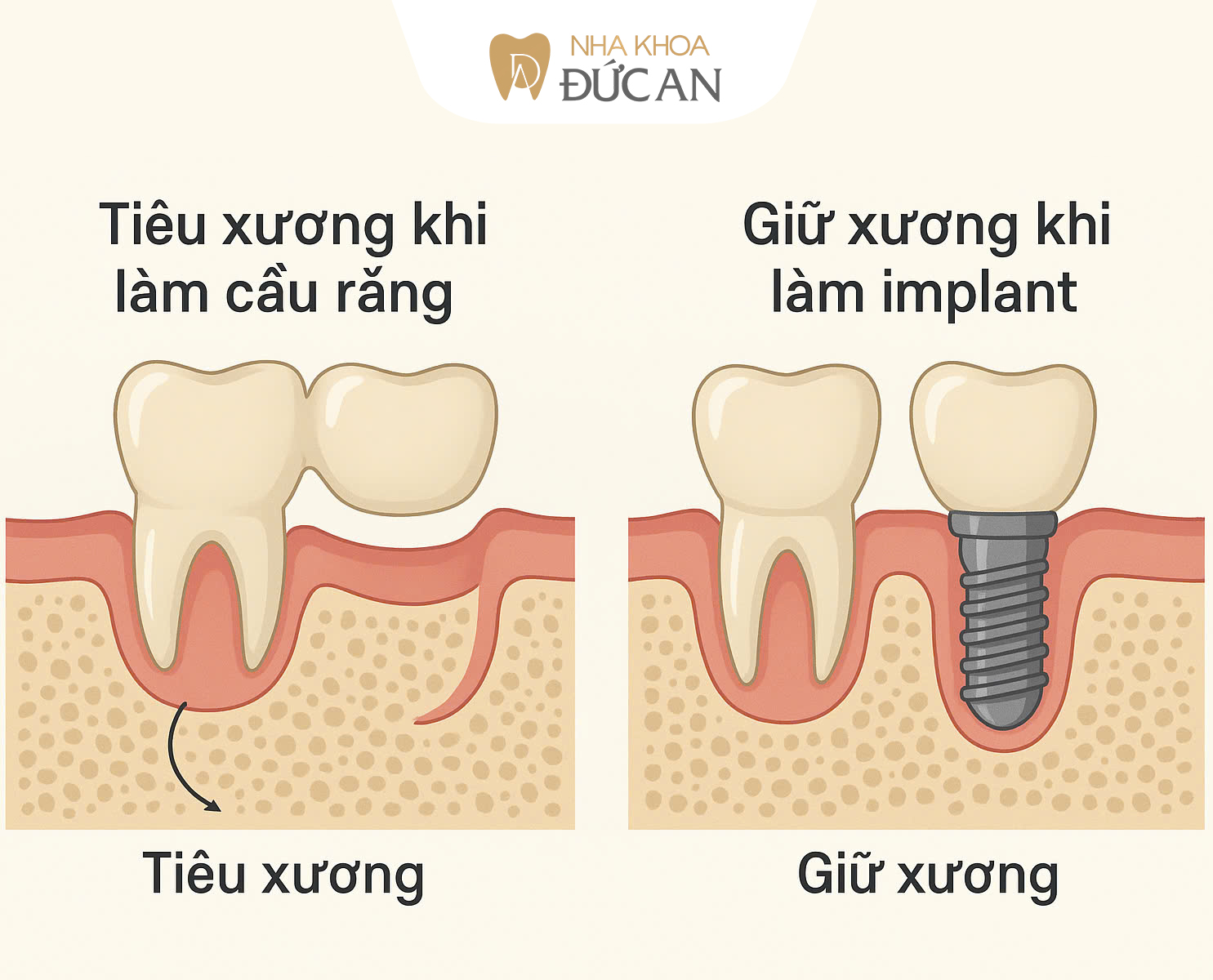 So sánh Cầu Răng và Implant – Giải pháp nào bền vững hơn?