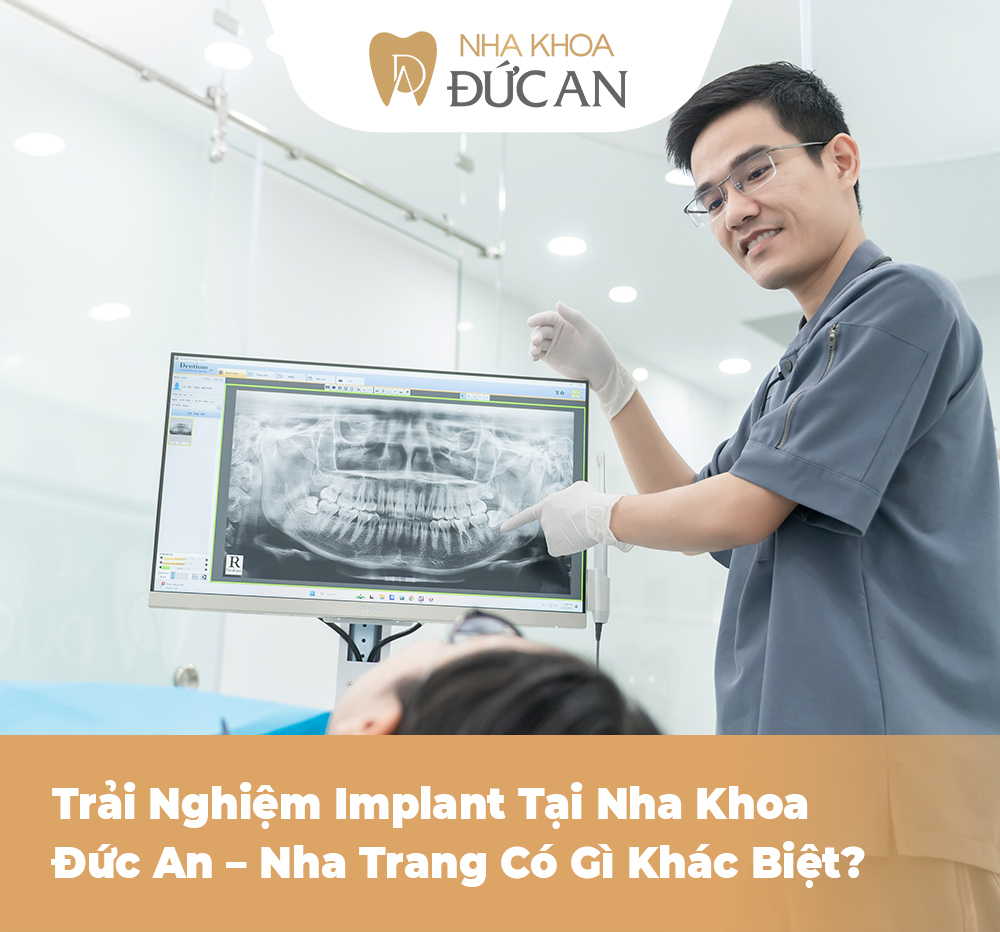 Trải Nghiệm Implant Tại Nha Trang Khiến Ai Cũng Muốn Làm Ngay