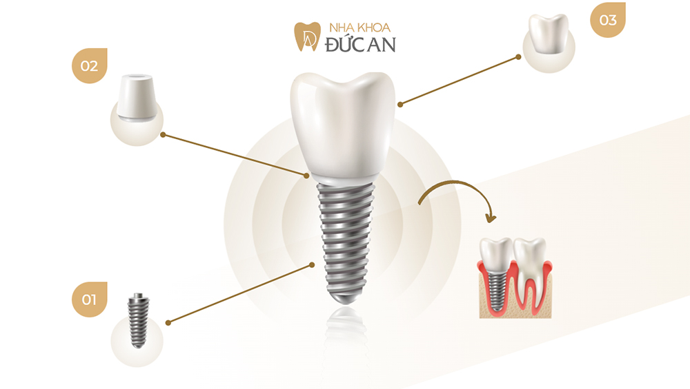 Implant Là Gì? Vì Sao Ngày Càng Nhiều Người Chọn Thay Thế Răng Mất Bằng Implant?