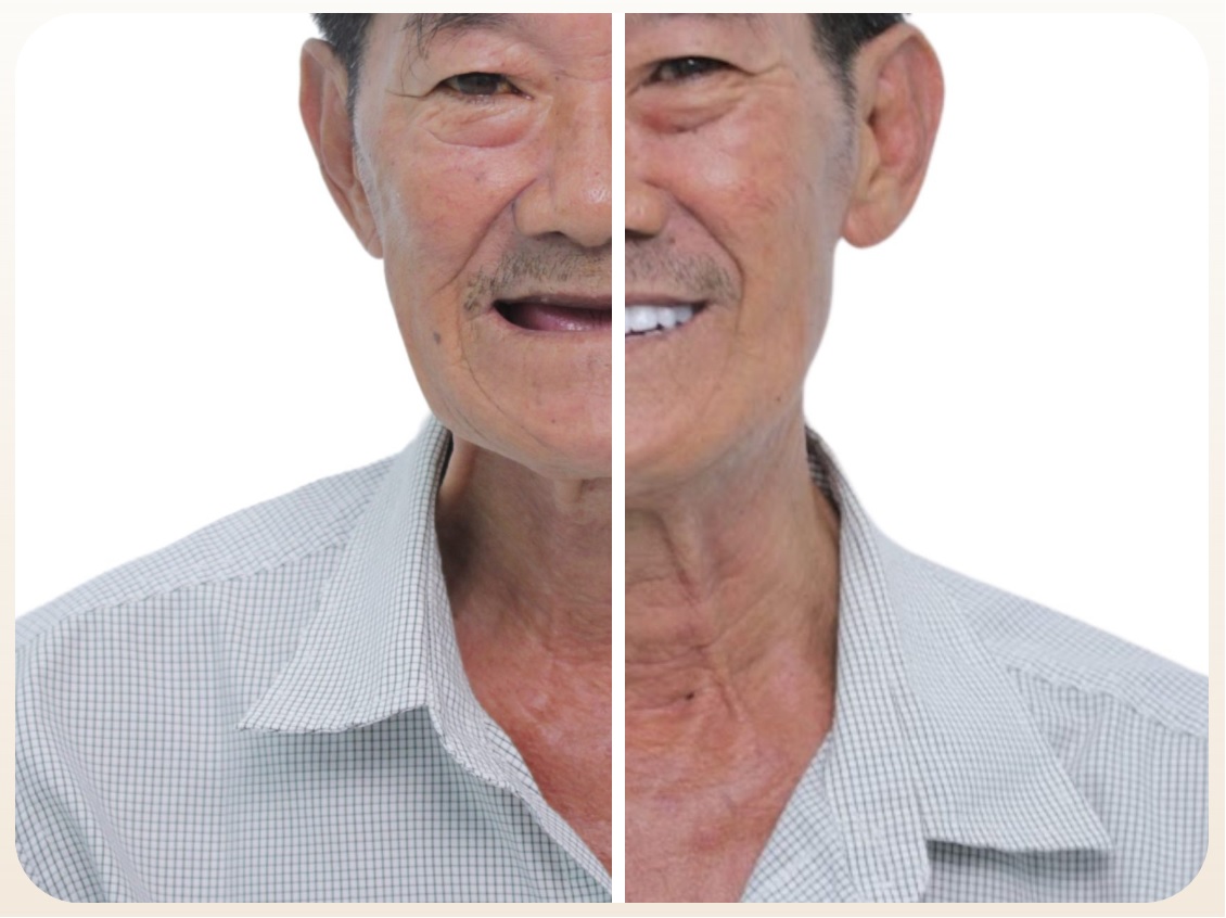 Trải nghiệm khách hàng trồng implant 2 hàm tại Nha Khoa Đức An Nha Trang