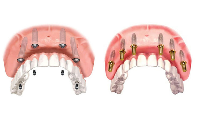 implant all on 4 / all on 6 tại Nha Khoa Đức An Nha Trang