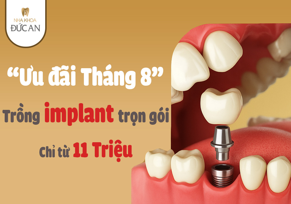 Trồng implant chỉ từ 11 triệu tại Nha Khoa Đức An Nha Trang