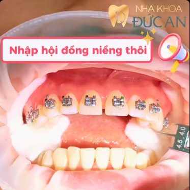 Niềng răng Nha Trang