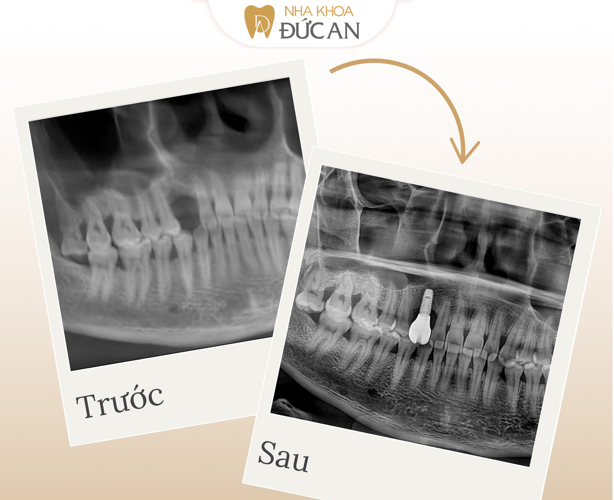 Implant tại Nha Khoa Đức An Nha Trang