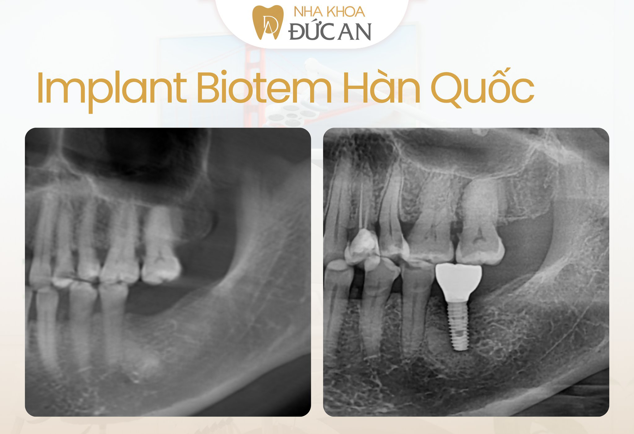 Implant cho người mất răng tại Nha Trang 