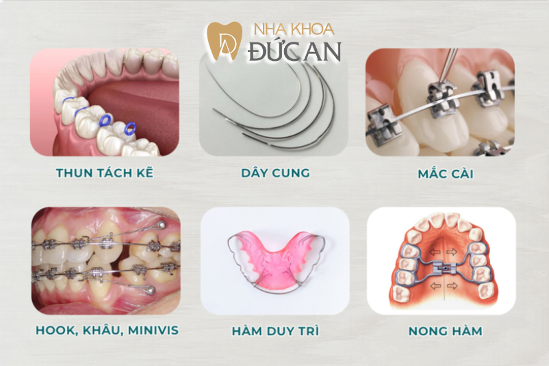 Khí cụ niềng răng | Nha Khoa Đức An Nha Trang