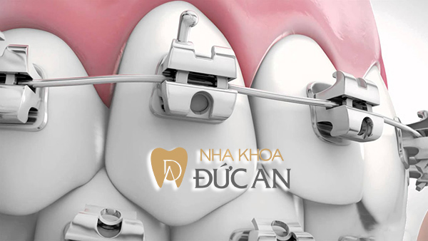 Niềng răng mắc cài tự buộc | Nha Khoa Đức An Nha Trang