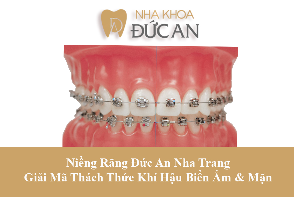 Niềng Răng Nha Trang: Giải Mã Thách Thức Khí Hậu Biển Ẩm & Mặn
