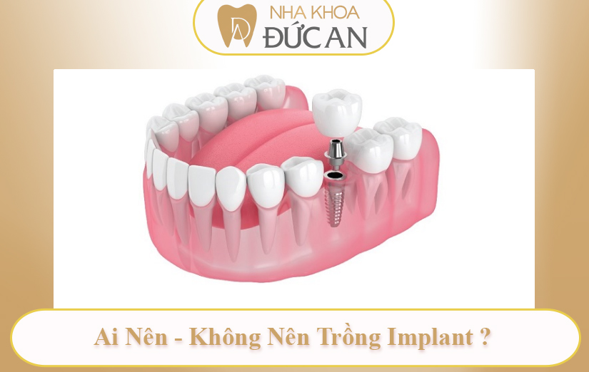 Review A-Z Kiến Thức Implant Chuyên Sâu Tại Nha Khoa Đức An Nha Trang