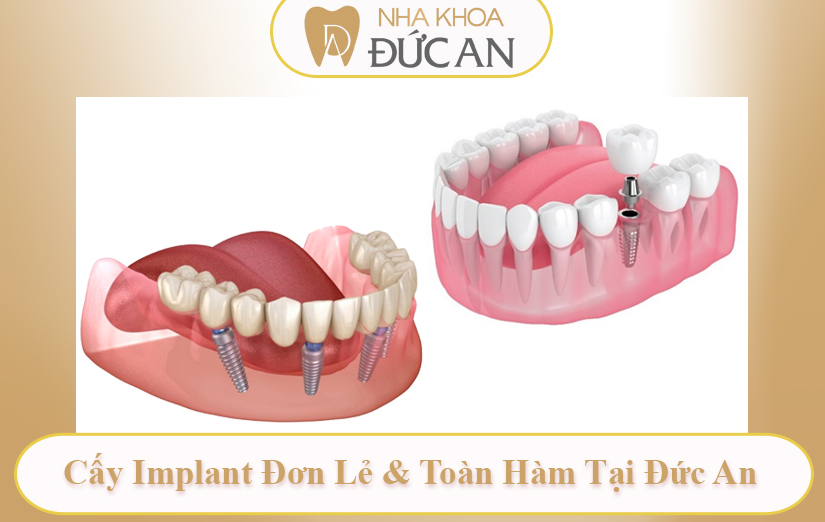 Review A-Z Kiến Thức Implant Chuyên Sâu Tại Nha Khoa Đức An Nha Trang