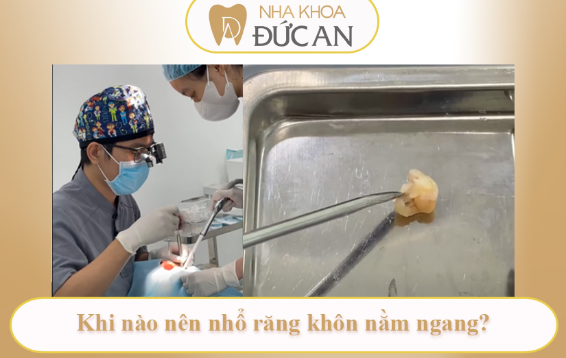 Vì Sao Răng Khôn Nằm Ngang Nên Nhổ Sớm? Cảnh Báo Biến Chứng Và Giải Pháp An Toàn Tại Nha Khoa Đức An Nha Trang