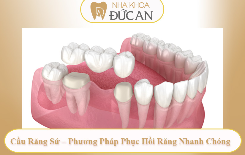Cầu Răng Sứ – Phương Pháp Phục Hồi Răng Nhanh Chóng