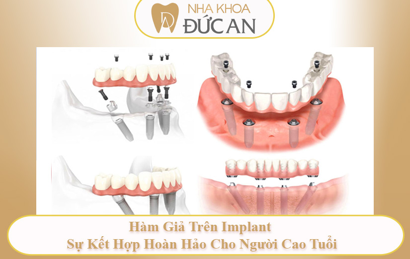 Top 5 Phương Pháp Trồng Răng Giả Cho Người Già Tốt Nhất Hiện Nay Tại Đức An Nha Trang| Hàm giả và imlant