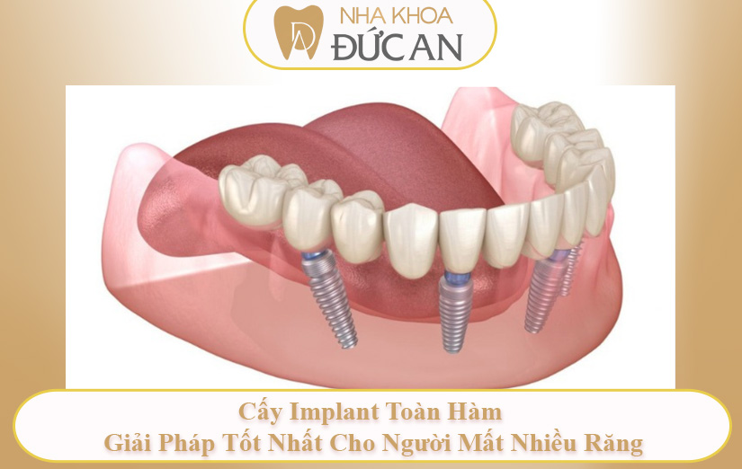 Top 5 Phương Pháp Trồng Răng Giả Cho Người Già Tốt Nhất Hiện Nay Tại Đức An Nha Trang | Implant Nha Trang
