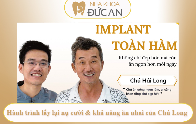 Mất Răng Lâu Năm: Câu Chuyện Implant Toàn Hàm Tại Nha Khoa Đức An Nha Trang