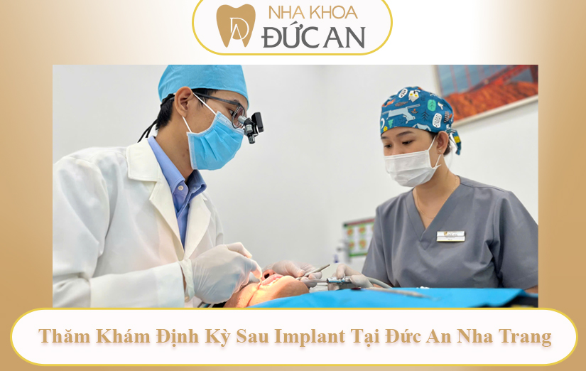 Trồng Implant răng cửa tại Nha Khoa Đức An – Phục hồi thẩm mỹ & chức năng tự nhiên như răng thật