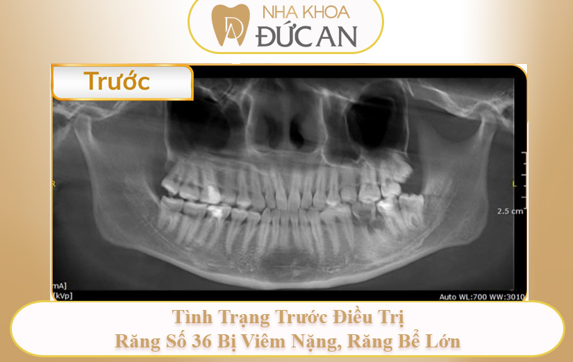 Khách Hàng Cấy Implant Neodent – Phục Hồi Nhanh Chóng Tại Nha Khoa Đức An Nha Trang