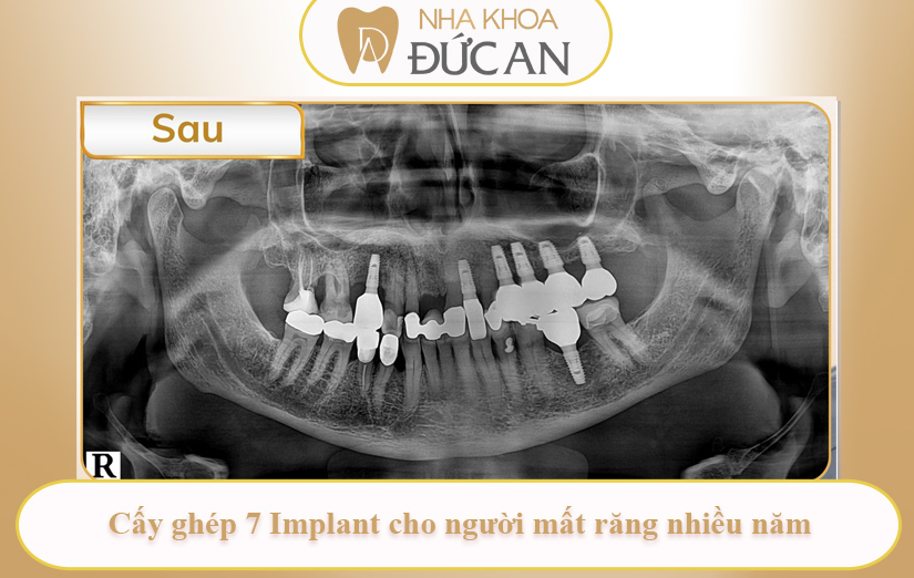 Câu chuyện khách hàng: Cấy 7 trụ Implant – Hành trình lấy lại nụ cười vững chắc tại Nha Khoa Đức An Nha Trang