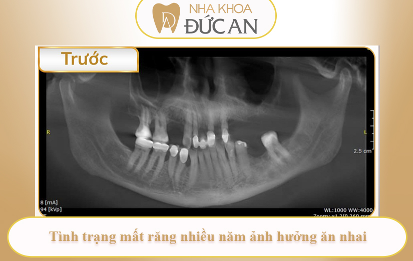 Câu chuyện khách hàng: Cấy 7 trụ Implant – Hành trình lấy lại nụ cười vững chắc tại Nha Khoa Đức An Nha Trang
