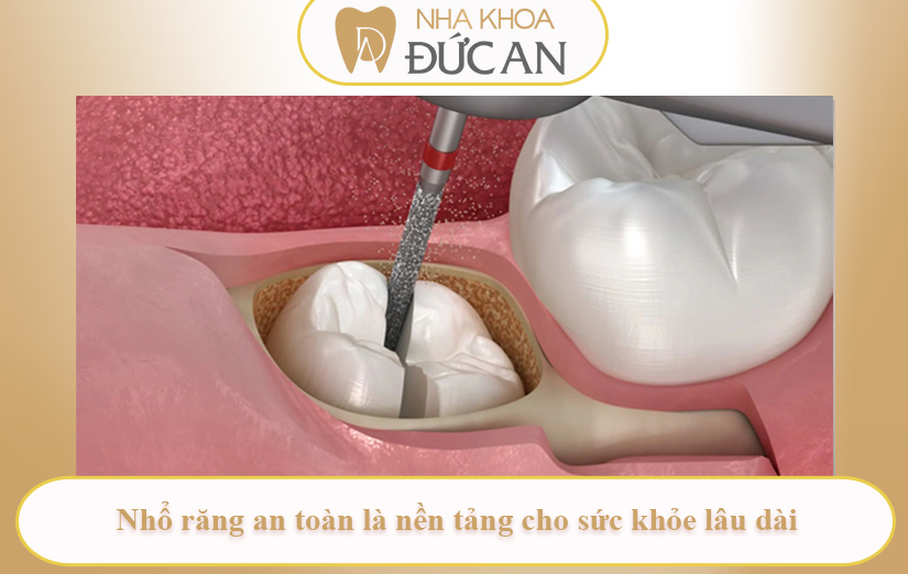 Nhổ răng khôn bị sót chân răng – nỗi lo kéo dài tại Nha Khoa Nha Trang chất lượng kém