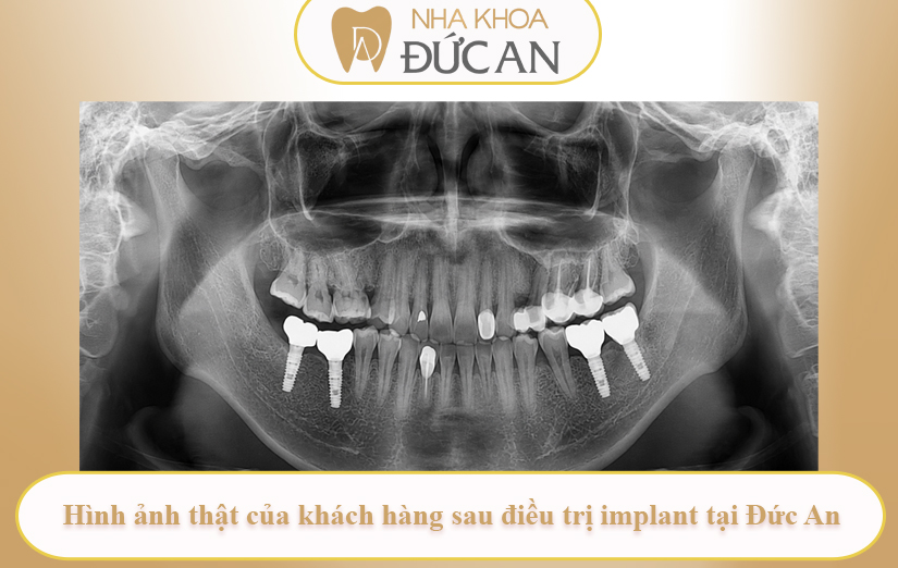Khách hàng Quốc Tuấn – Hành trình trồng răng Implant tại Nha Khoa Đức An Nha Trang