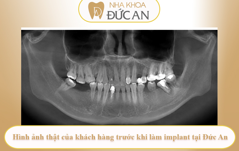 Khách hàng Quốc Tuấn – Hành trình trồng răng Implant tại Nha Khoa Đức An Nha Trang