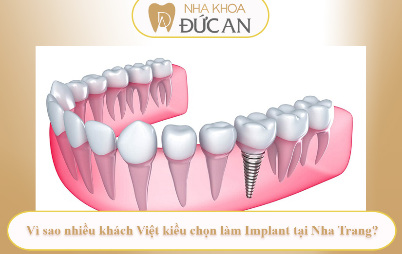 Vì sao khách nước ngoài chọn cấy implant tại Nha Trang Việt Nam