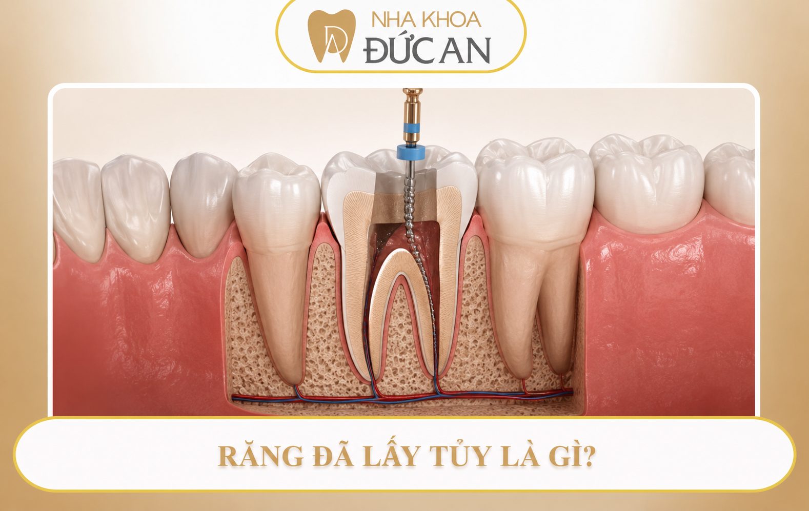 Răng Lấy Tủy Có Niềng Được Không? Chuyên Gia Nha Khoa Đức An Nha Trang Giải Đáp