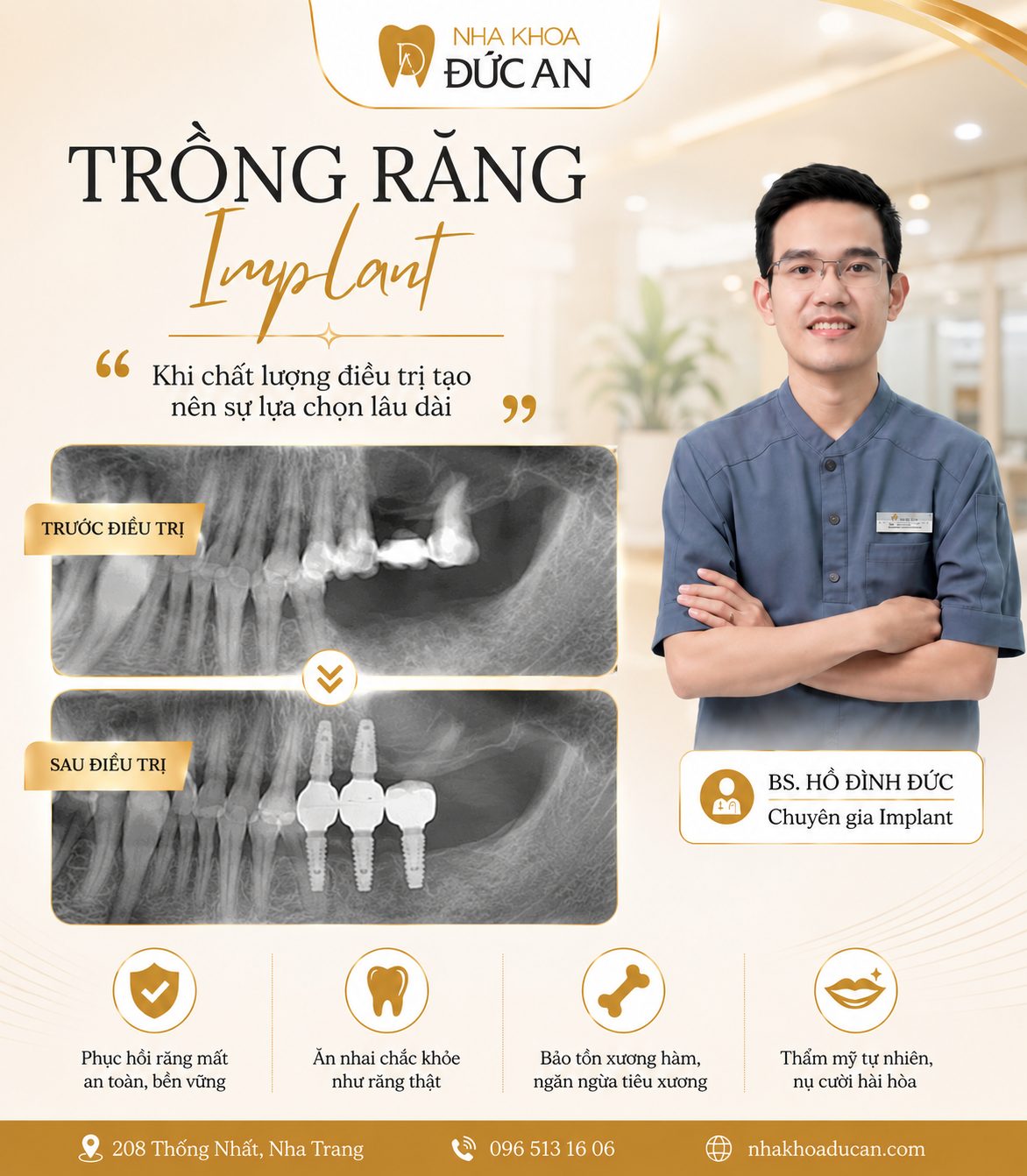 Trồng 4 trụ Implant tại Nha Khoa Đức An Nha Trang bằng niềm tin xây dựng nhiều năm
