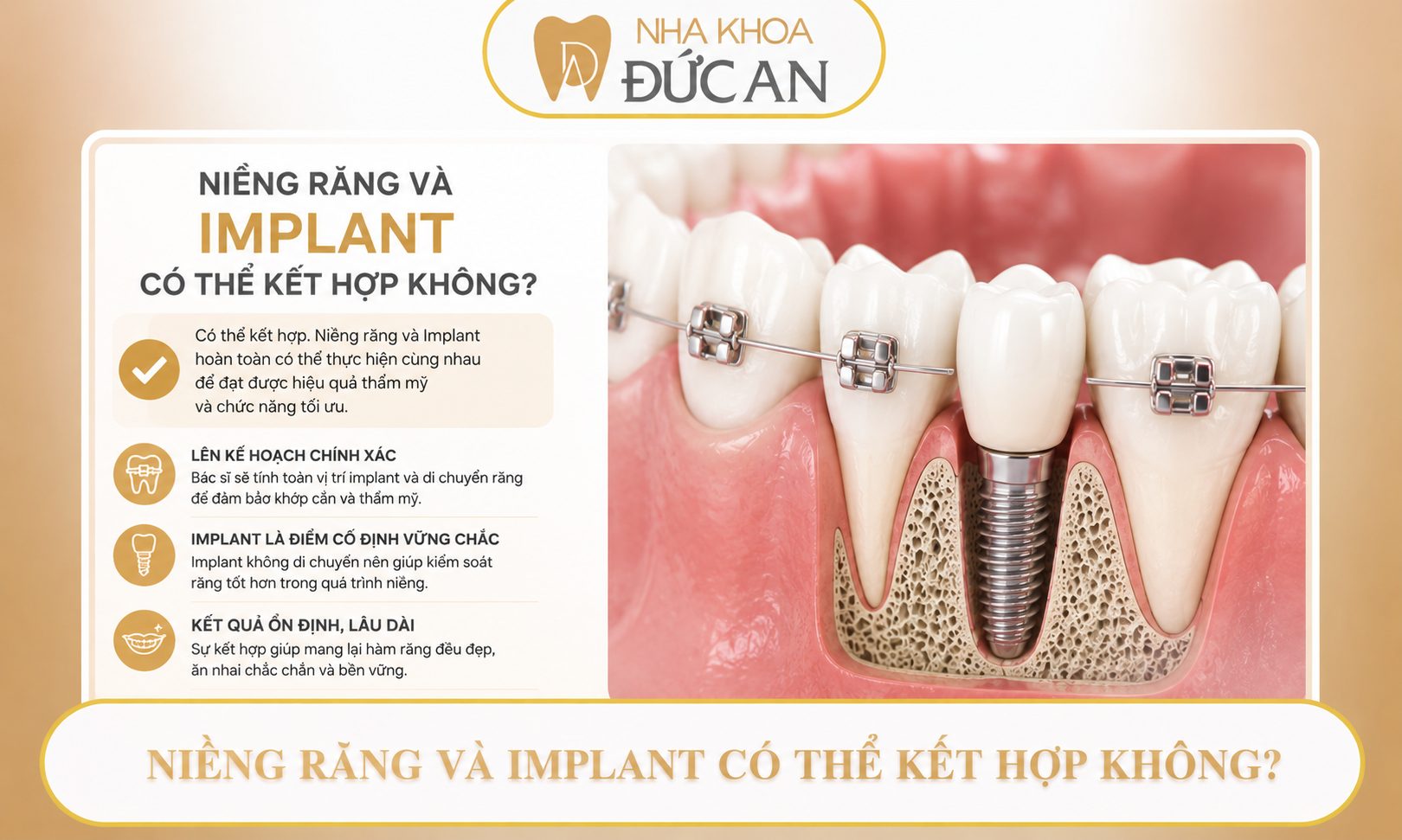 Răng Lấy Tủy Có Niềng Được Không? Chuyên Gia Nha Khoa Đức An Nha Trang Giải Đáp