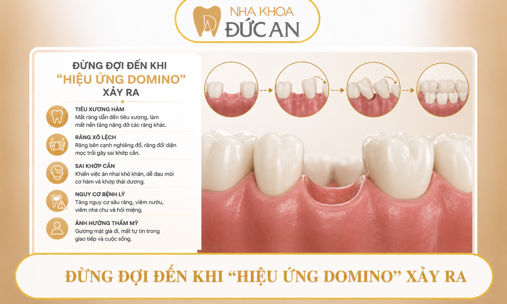Đừng chủ quan khi mất 1 răng - Cảnh báo từ chuyên gia implant Nha Trang