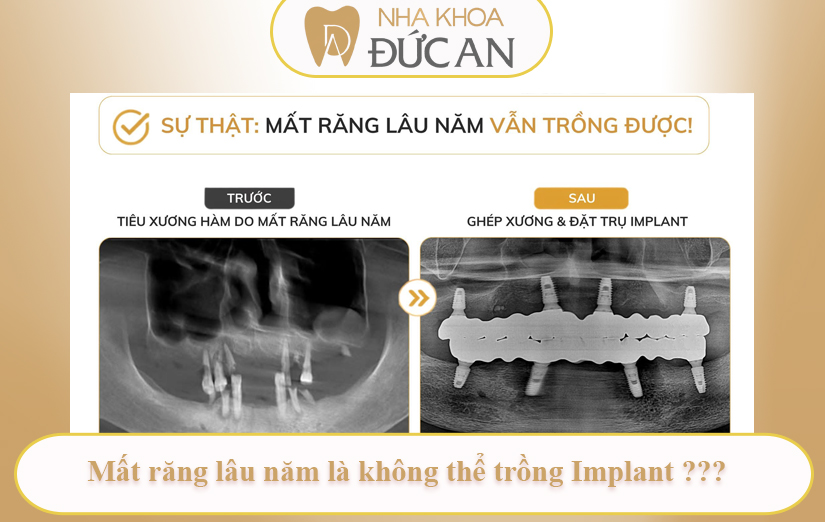 5 hiểu lầm về implant Nha Trang khiến nhiều người trì hoãn trồng răng suốt nhiều năm