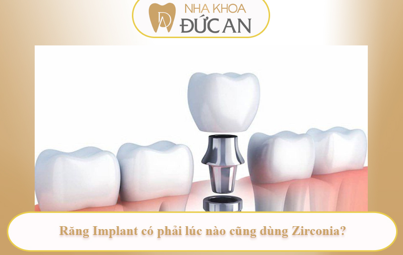 Răng toàn sứ trên implant là gì? Vì sao nha sĩ Nha Trang khuyên chọn sứ Zirconia?
