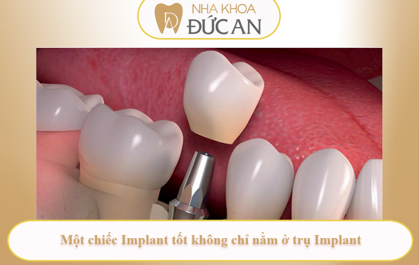 Răng toàn sứ trên implant là gì? Vì sao nha sĩ Nha Trang khuyên chọn sứ Zirconia?