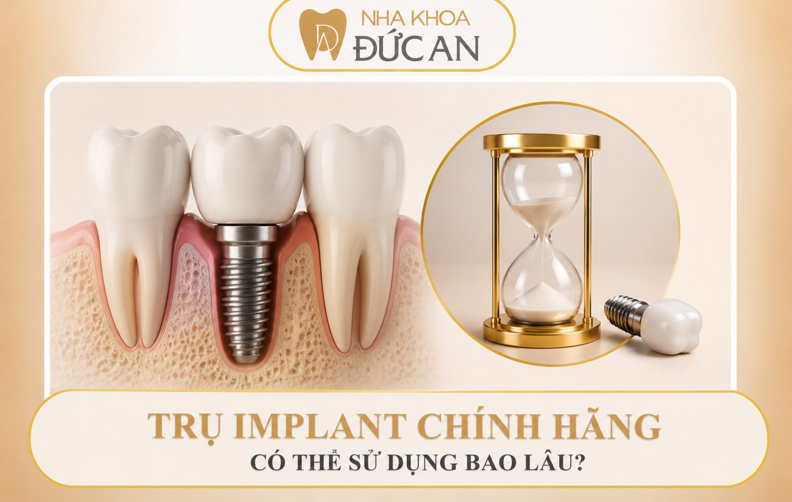 Bảo hành 5 năm là Implant sẽ hư? BS Implant Nha Trang giải đáp