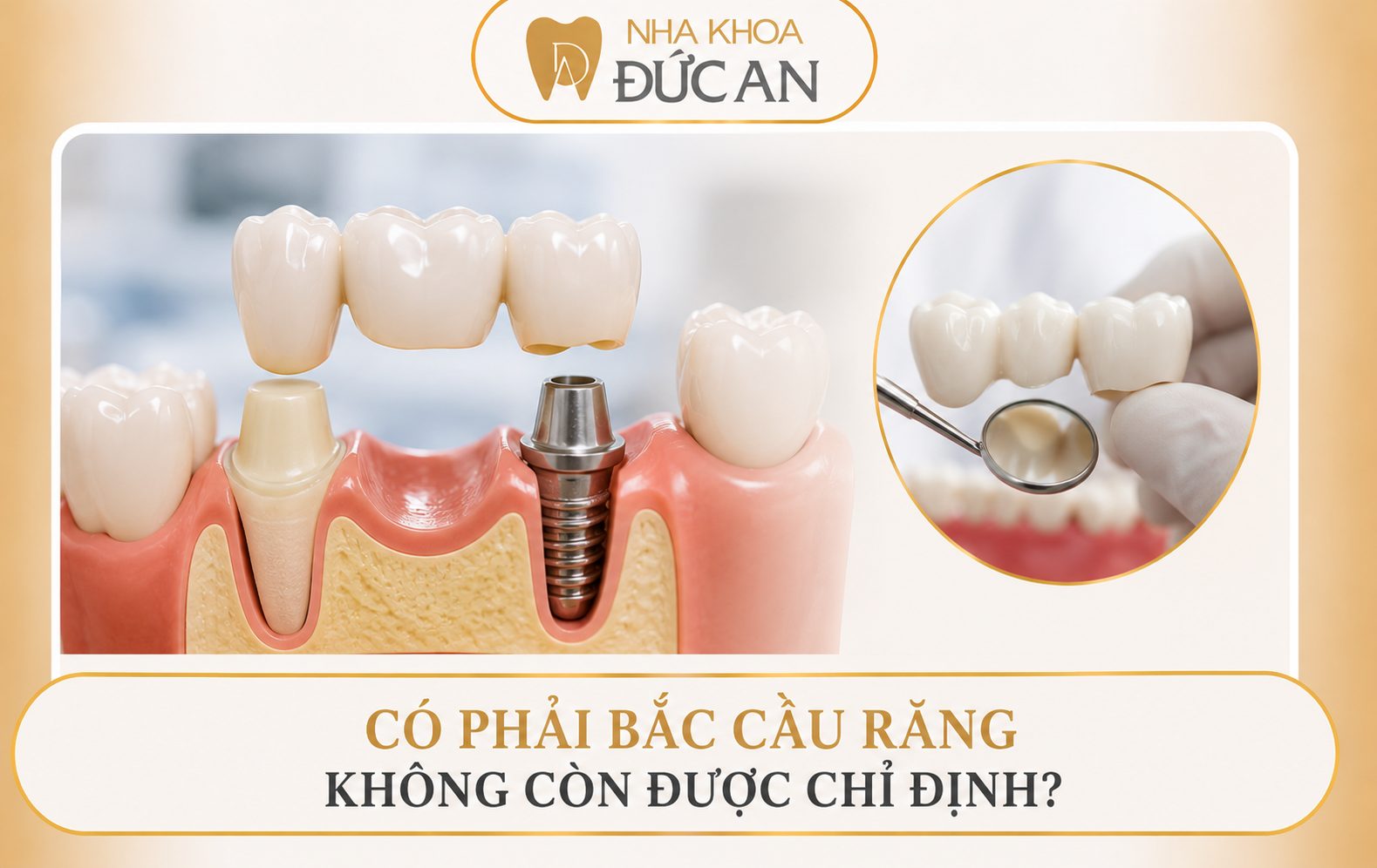Bắc Cầu Răng - Góc Nhìn Chuyên Gia Implant Từ Nha Khoa Đức An Nha Trang