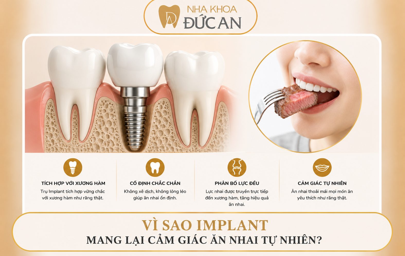 Khách Hàng Thủy Triều Trồng 2 Răng Implant Tại Nha Khoa Đức An Nha Trang - Quyết Định Từ Một Lần Tìm Hiểu